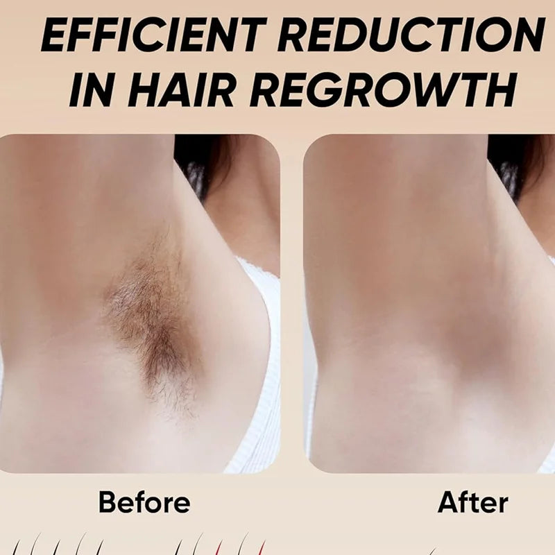 Laser Hair Removal Device - Lipatrend 